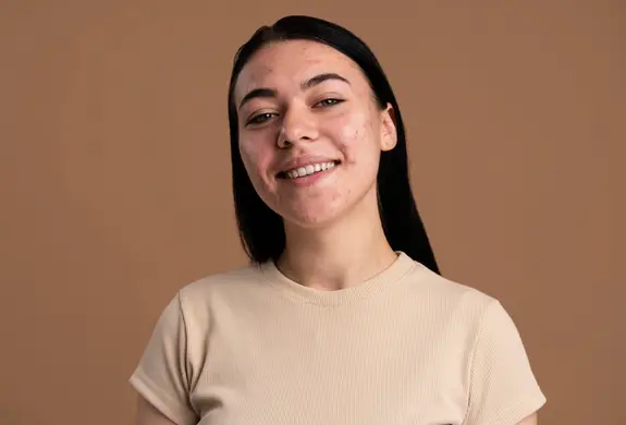 Acne scars – Diagnosis and treatment