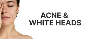 image for acne supplements and products